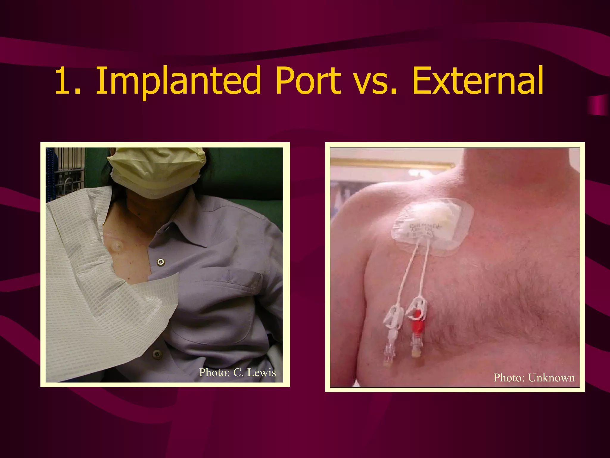 1. Implanted Port vs. External  Photo: C. Lewis Photo: Unknown 