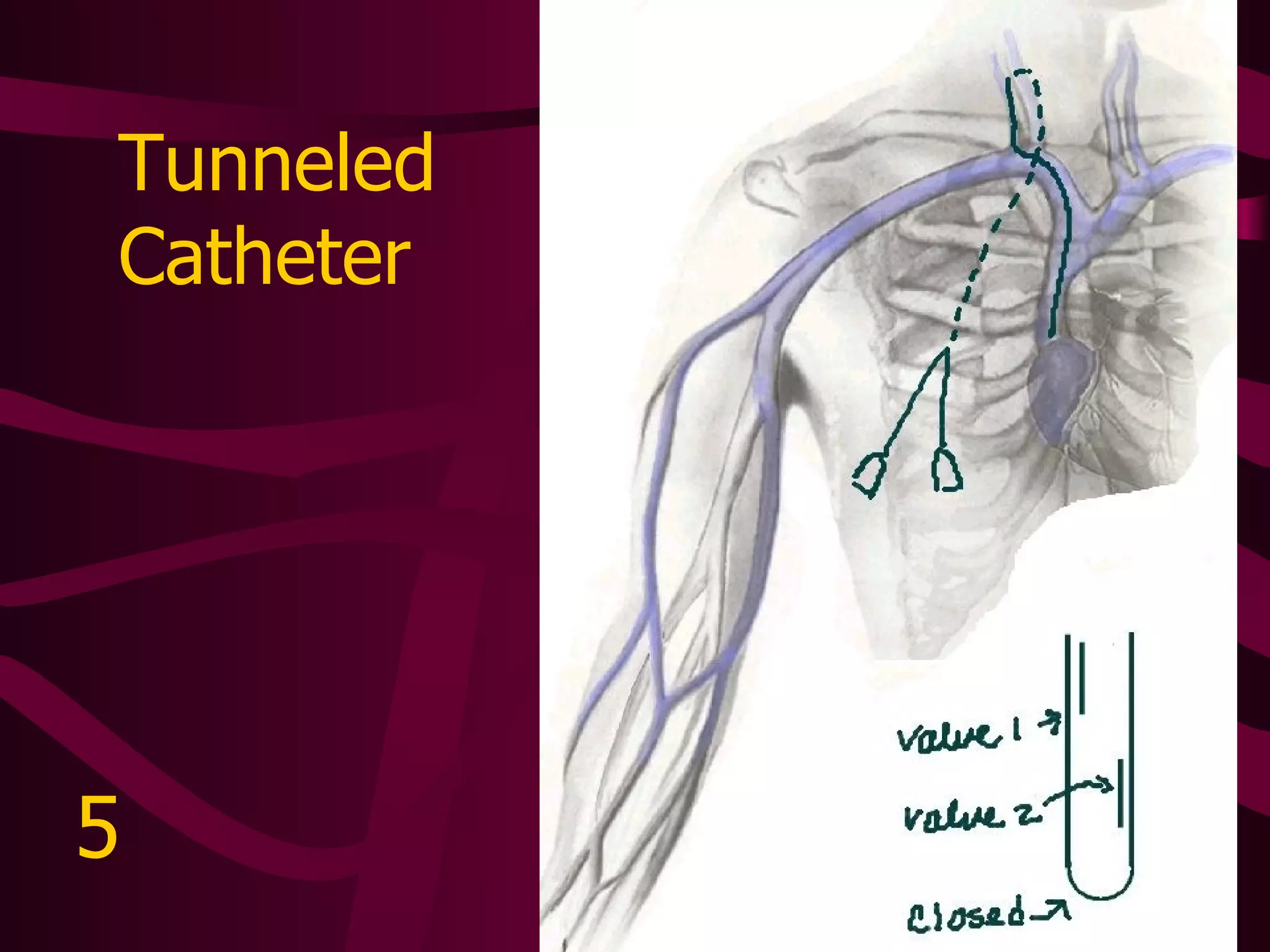 Summary The key is to correctly identify the type of catheter Based on that, you can appropriately assess and maintain the catheter 