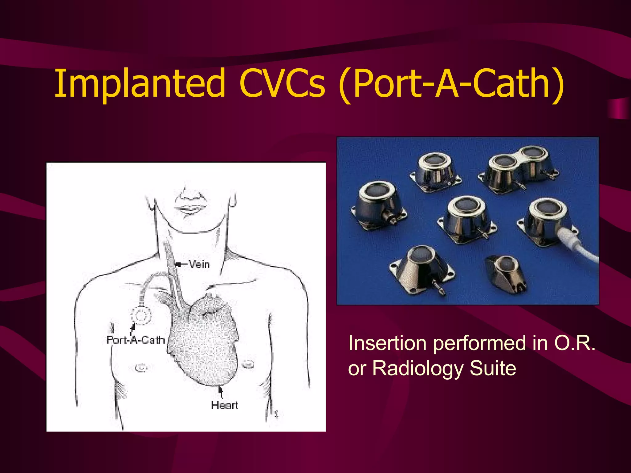 Implanted CVCs (Port-A-Cath) Insertion performed in O.R. or Radiology Suite 