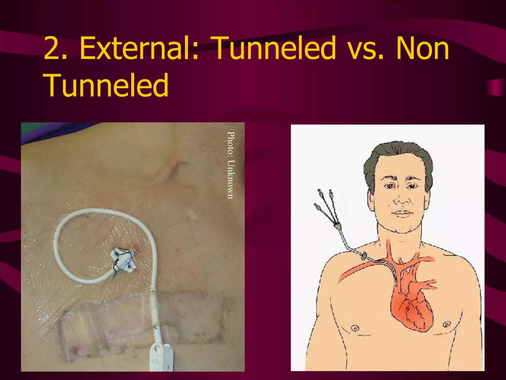 2. External: Tunneled vs. Non Tunneled Photo: Unknown 