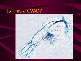 Assessing for Complications Do bag-to-tip check Examination of catheter tract is more involved for central line Start with port site or skin entry site Visually inspect along tunnel (if any) to venous entry site Mentally think about where tip is and the  complications that can arise 