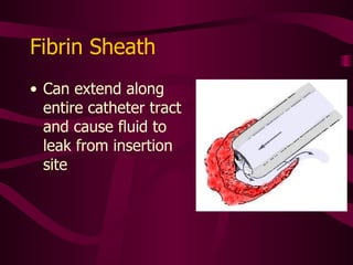 Fibrin Sheath Partial or total 