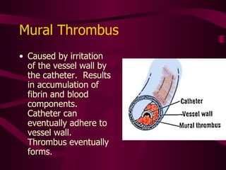 Fibrin Tail Can infuse but not aspirate Infusate pushes fibrin out of the way Aspiration pulls fibrin tail into catheter opening causes obstruction Left untreated, it eventually becomes total occlusion 