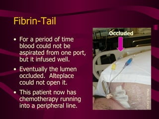 Fibrin Occlusion May be Amenable to Thrombolytic Therapy Intraluminal clot Fibrin sheath Fibrin tail Mural thrombus 