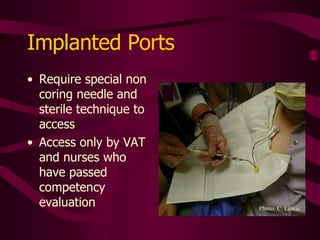 Accessed Port-A-Caths One the port is accessed, the non-coring needle can stay in for a period of time, depending on protocol. 