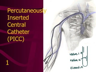 Implanted Vascular Access Device (Port-A-Cath) 2 