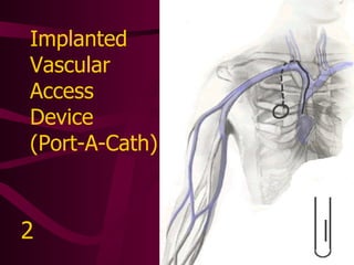 Subclavian Hickman Catheter 3 