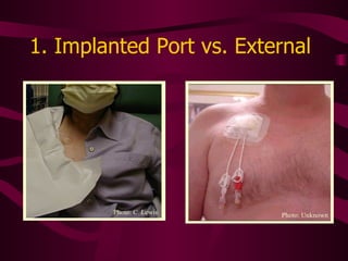 1. Implanted Port vs. External  Photo: C. Lewis Photo: Unknown 