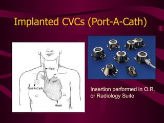 Implanted CVCs (Port-A-Cath) Insertion performed in O.R. or Radiology Suite 