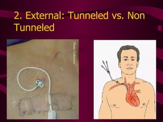 2. External: Tunneled vs. Non Tunneled Photo: Unknown 
