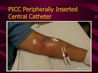 Peripherally Inserted Central Catheter (PICC) Photo: C. Lewis 
