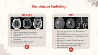 ● Hipodens
● Hilangnya visualisasi pita insular
● Hilangnya garis tatanan nukleus
lentiformis
● Hilangnya diferensiasi antara substansia
grisea-alba
● Penyempitan sulkus korteks
● Komptesi ventrikel lateral
● DWI) sangat sensitif terhadap edema
cerebri awal
● DWI MRI dapat mendeteksi iskemia jauh
lebih awal daripada CT scan standar atau
spin echo
● Lesi iskemik pada MRI akan tampak
hipointens.
● Pada sekuen DWI stroke yang masih
baru akan tampak sebagai area
hiperintensitas
Gambaran Radiologi
CT Scan MRI
 
