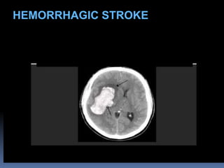 HEMORRHAGIC STROKE
 