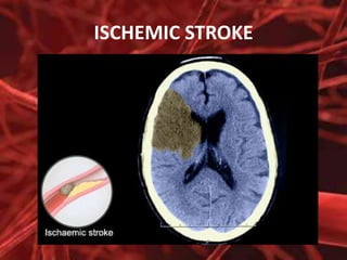 ISCHEMIC STROKE

 
