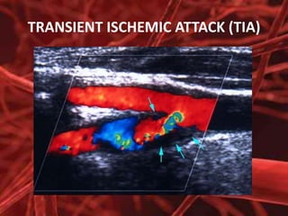 TRANSIENT ISCHEMIC ATTACK (TIA)

 