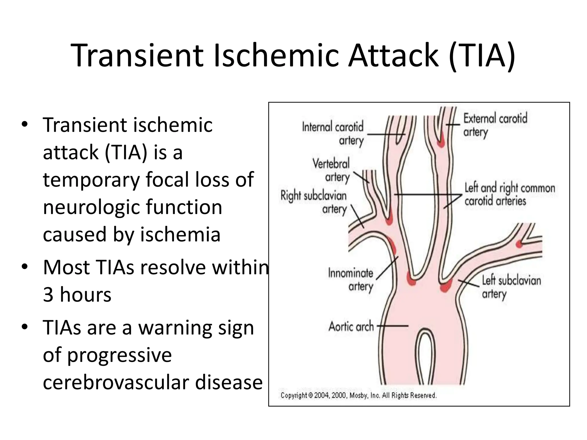 Transient Ischemic Attack (TIA)
• Transient ischemic
attack (TIA) is a
temporary focal loss of
neurologic function
caused by ischemia
• Most TIAs resolve within
3 hours
• TIAs are a warning sign
of progressive
cerebrovascular disease
 