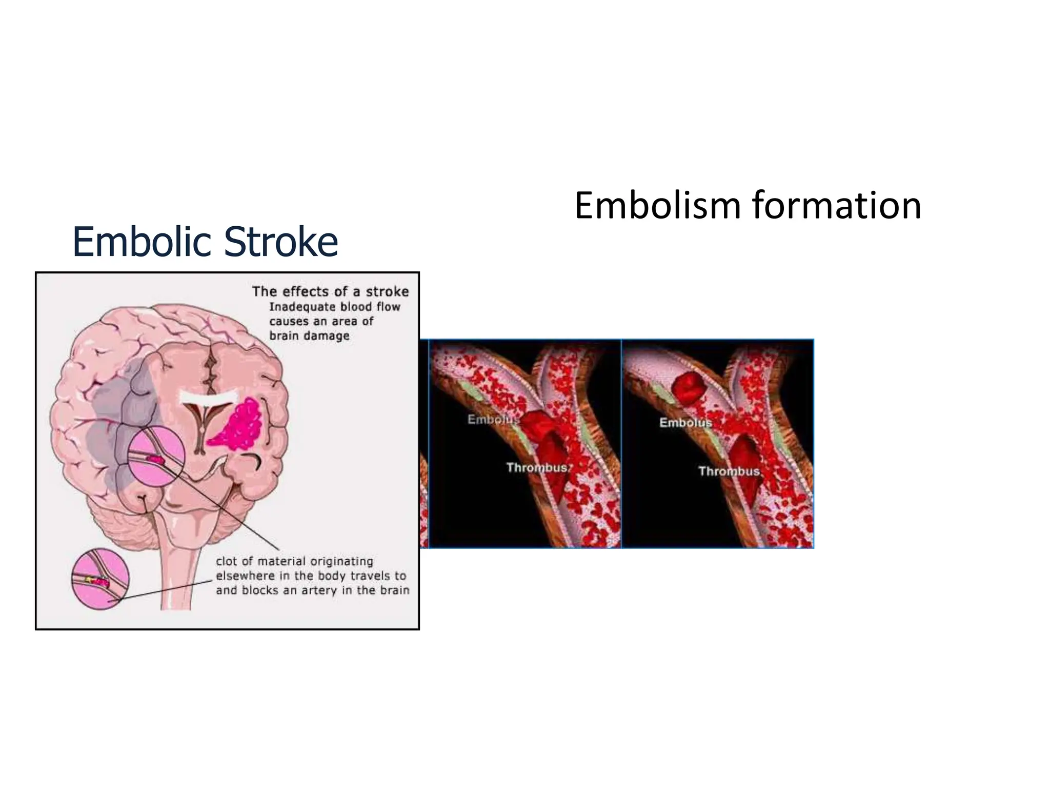 Embolism formation
Embolic Stroke
 