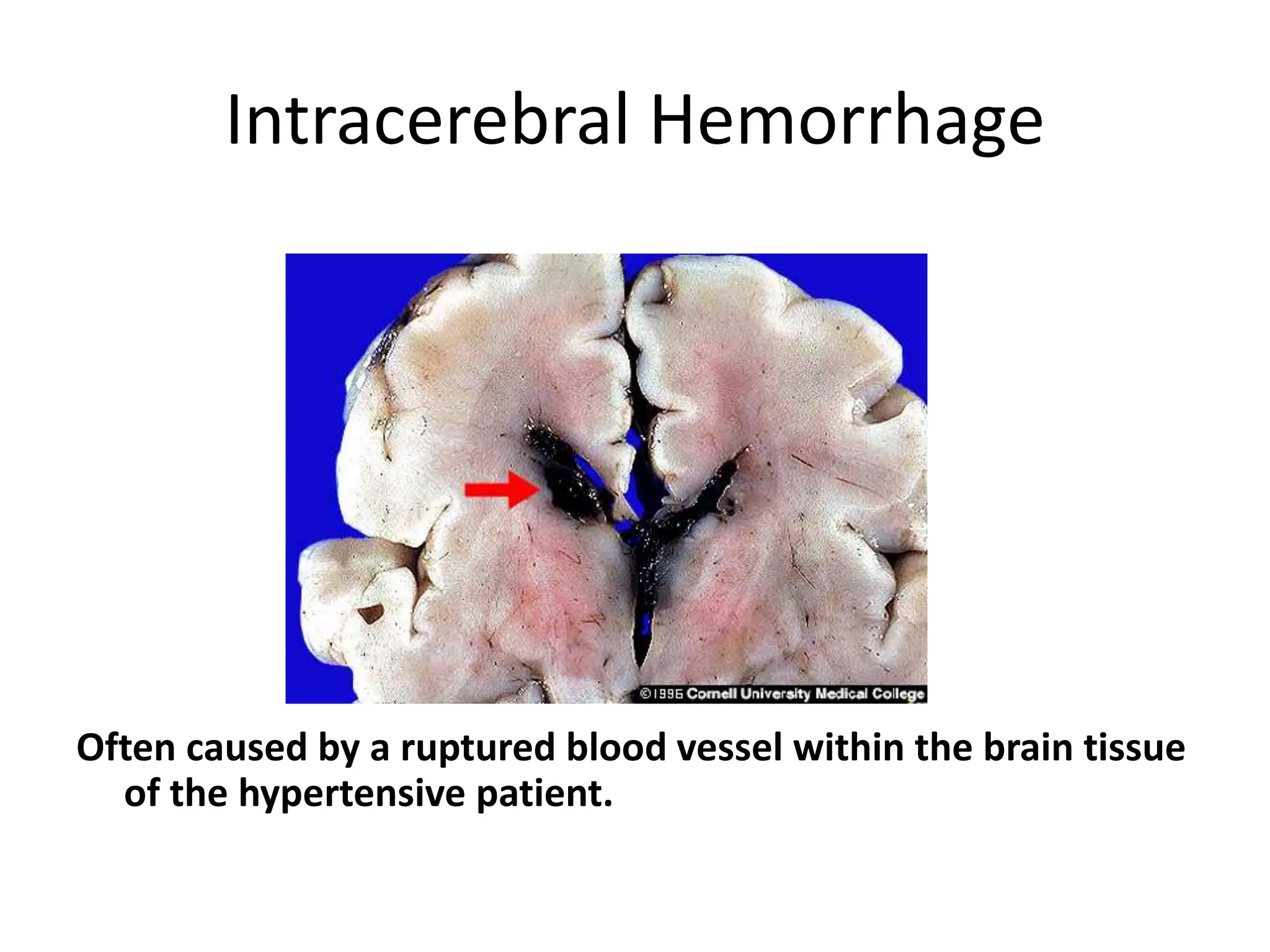 Intracerebral Hemorrhage
Often caused by a ruptured blood vessel within the brain tissue
of the hypertensive patient.
 