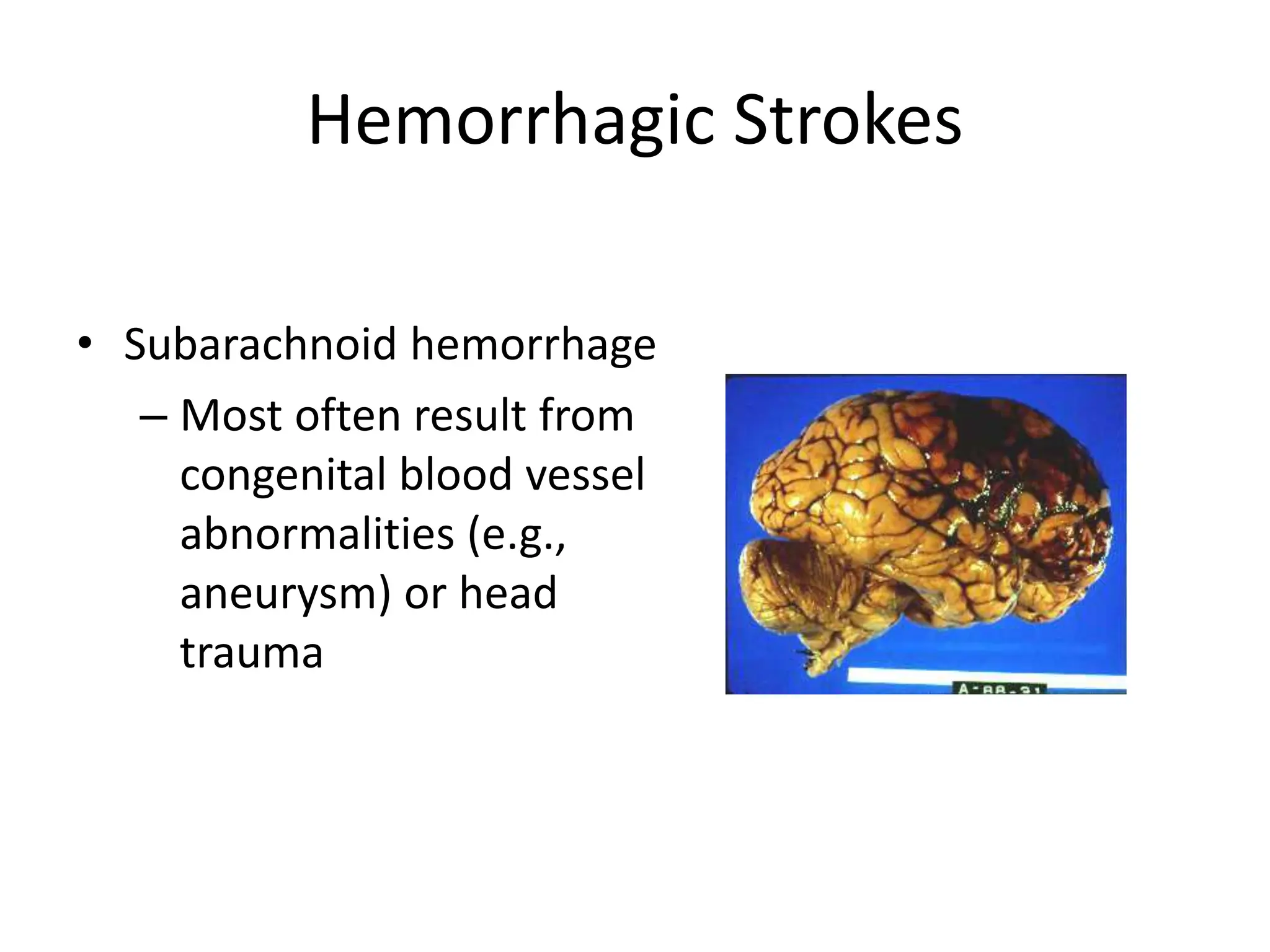 Hemorrhagic Strokes
• Subarachnoid hemorrhage
– Most often result from
congenital blood vessel
abnormalities (e.g.,
aneurysm) or head
trauma
 