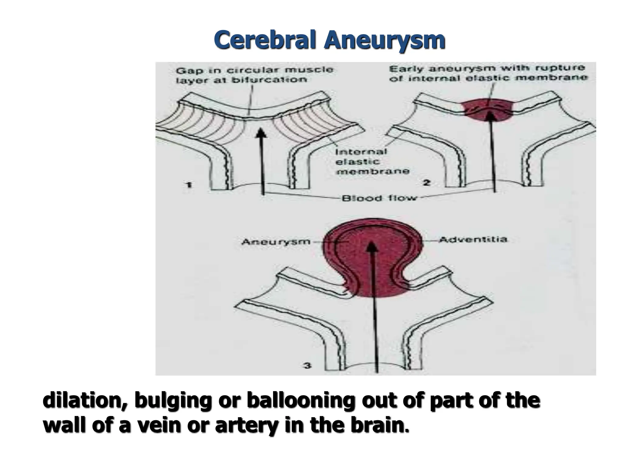 dilation, bulging or ballooning out of part of the
wall of a vein or artery in the brain.
Cerebral Aneurysm
 