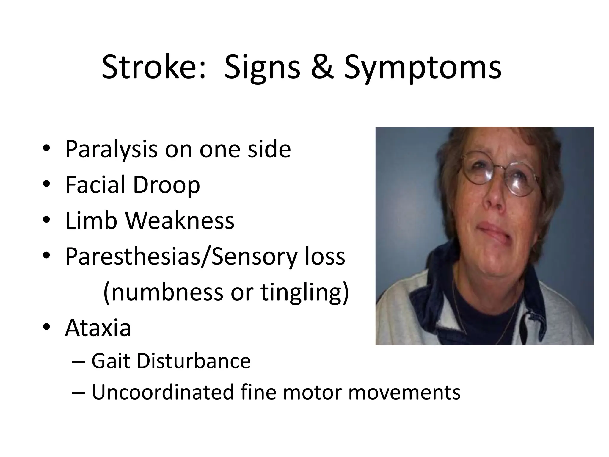 Stroke: Signs & Symptoms
• Paralysis on one side
• Facial Droop
• Limb Weakness
• Paresthesias/Sensory loss
(numbness or tingling)
• Ataxia
– Gait Disturbance
– Uncoordinated fine motor movements
 