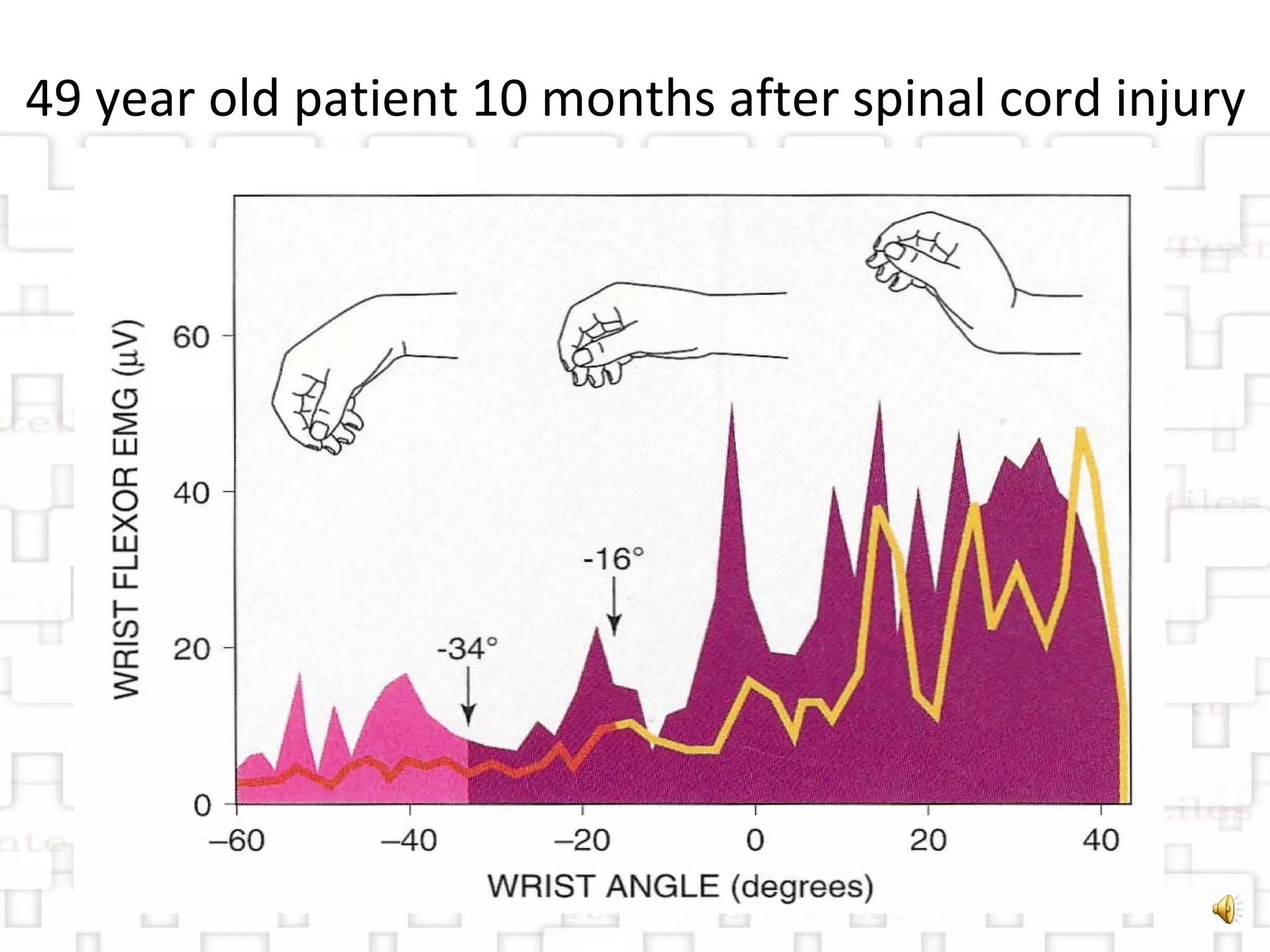 49 year old patient 10 months after spinal cord injury 