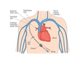 C.V.C 99 .pptx central venous access lecture | PPTX