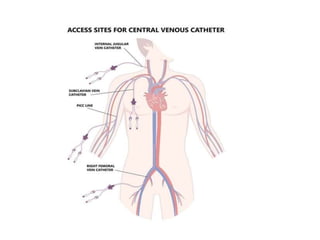 C.V.C 99 .pptx central venous access lecture | PPTX