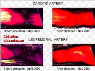 ChélationChélation
IntraveineuseIntraveineuse
 