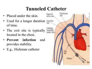 Image Hickman Process Hickman Catheter Care