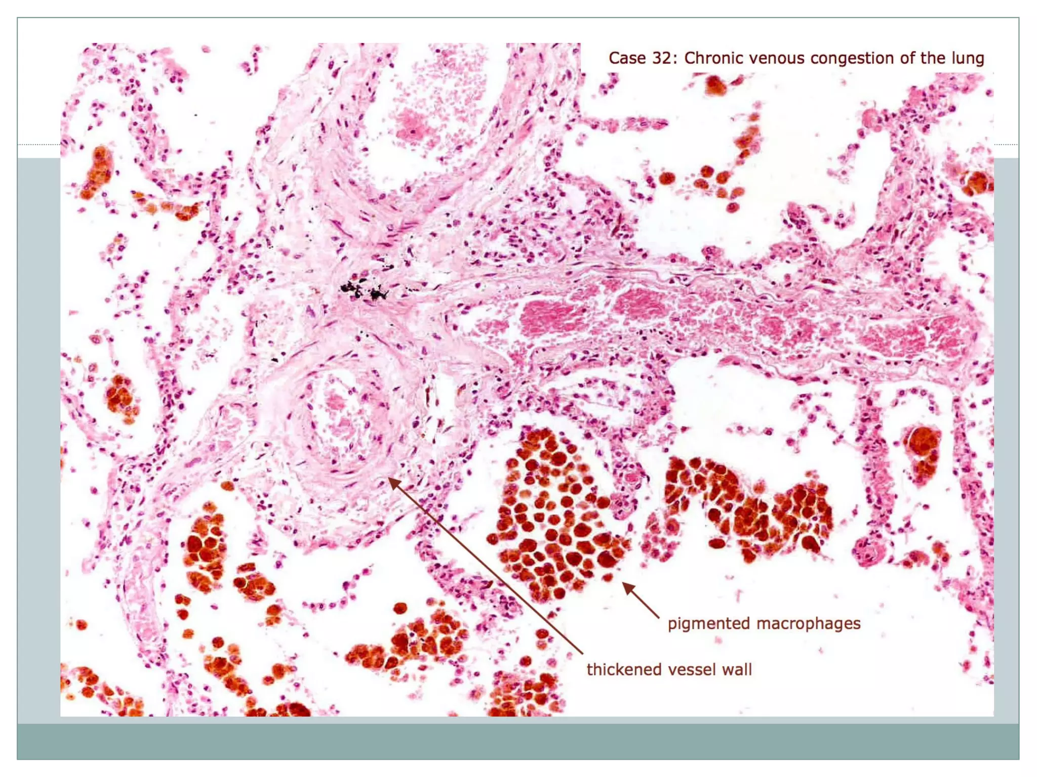 Cvc lung, liver and spleen PPT