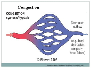 Downloaded from: Robbins & Cotran Pathologic Basis of Disease (on 27 June 2005 07:26 PM)
© 2005 Elsevier
Congestion
 