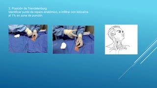 2. Posición de Trendelenburg
Identificar punto de reparo anatómico, e infiltrar con lidocaína
al 1% en zona de punción
 