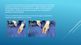 3. Una vez encontrándose en la parte posterior del borde óseo se redirige
la aguja en dirección a la horquilla esternal. • Dirigir la aguja en dirección
a la horquilla esternal, con la intención de canalizar la vena subclavia,
introduciendo y aspirando de manera constante, con la finalidad de
identificar la vena subclavia.
4. Una vez obtenido sangre venosa a través de la aguja, se procede a
introducir la guía metálica por la misma
 