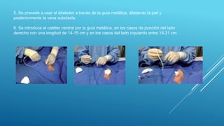 5. Se procede a usar el dilatador a través de la guía metálica, dilatando la piel y
posteriormente la vena subclavia.
6. Se introduce el catéter central por la guía metálica, en los casos de punción del lado
derecho con una longitud de 14-15 cm y en los casos del lado izquierdo entre 19-21 cm.
 