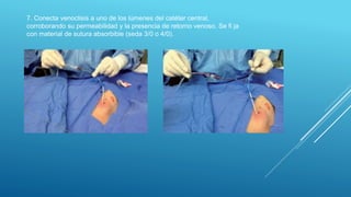 7. Conecta venoclisis a uno de los lúmenes del catéter central,
corroborando su permeabilidad y la presencia de retorno venoso. Se fi ja
con material de sutura absorbible (seda 3/0 o 4/0).
 