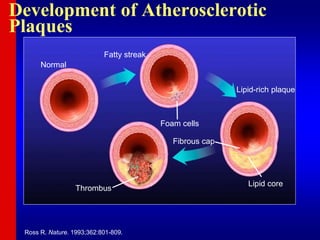 Development of Atherosclerotic
Plaques
Normal
Fatty streak
Foam cells
Lipid-rich plaque
Lipid core
Fibrous cap
Thrombus
Ross R. Nature. 1993;362:801-809.
 