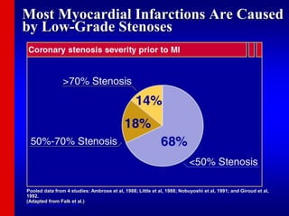 Most Myocardial Infarctions Are Caused
by Low-Grade Stenoses
Pooled data from 4 studies: Ambrose et al, 1988; Little et al, 1988; Nobuyoshi et al, 1991; and Giroud et al,
1992.
(Adapted from Falk et al.)
Falk E et al, Circulation, 1995.
 