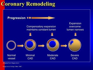 (Adapted from Glagov et al.)
Coronary Remodeling
Normal
vessel
Minimal
CAD
Progression
Compensatory expansion
maintains constant lumen
Expansion
overcome:
lumen narrows
Severe
CAD
Moderate
CAD
Glagov et al, N Engl J Med, 1987.
 
