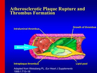 Intraluminal thrombus
Growth of thrombus
Intraplaque thrombus Lipid pool
Blood Flow
Atherosclerotic Plaque Rupture and
Thrombus Formation
Adapted from Weissberg PL. Eur Heart J Supplements
1999:1:T13–18
 