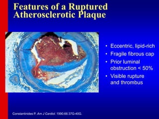 • Eccentric, lipid-rich
• Fragile fibrous cap
• Prior luminal
obstruction < 50%
• Visible rupture
and thrombus
Constantinides P. Am J Cardiol. 1990;66:37G-40G.
Features of a Ruptured
Atherosclerotic Plaque
 