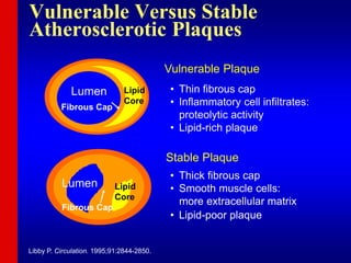Libby P. Circulation. 1995;91:2844-2850.
Vulnerable Plaque
• Thin fibrous cap
• Inflammatory cell infiltrates:
proteolytic activity
• Lipid-rich plaque
Lumen Lipid
Core
Fibrous Cap
• Thick fibrous cap
• Smooth muscle cells:
more extracellular matrix
• Lipid-poor plaque
Stable Plaque
Lumen Lipid
Core
Fibrous Cap
Vulnerable Versus Stable
Atherosclerotic Plaques
 