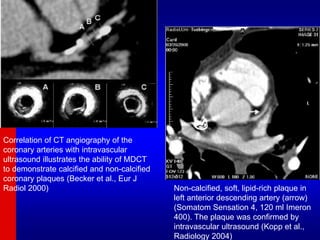 Correlation of CT angiography of the
coronary arteries with intravascular
ultrasound illustrates the ability of MDCT
to demonstrate calcified and non-calcified
coronary plaques (Becker et al., Eur J
Radiol 2000) Non-calcified, soft, lipid-rich plaque in
left anterior descending artery (arrow)
(Somatom Sensation 4, 120 ml Imeron
400). The plaque was confirmed by
intravascular ultrasound (Kopp et al.,
Radiology 2004)
 