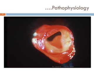 ….Pathophysiology
12/20/2024
7
By: Jemal B.
 