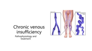 Chronic venous
insufficiency
Pathophysiology and
treatment
 