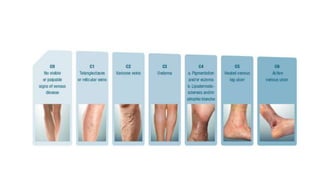 Symptoms of Varicose veins
• Edema : An increase in volume of
fluid in the skin and
subcutaneous tissue
characteristically...