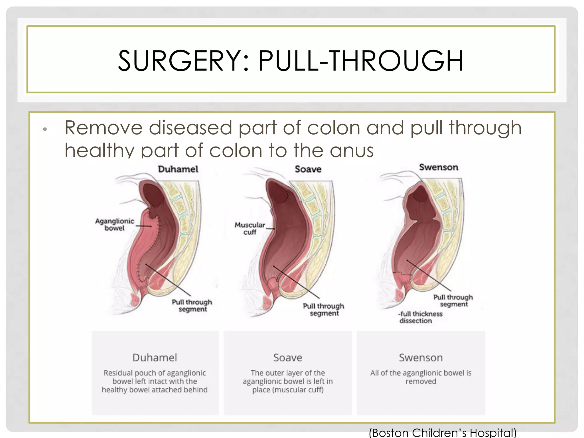 Pediatric Case Study of Hirschsprung Disease | PDF