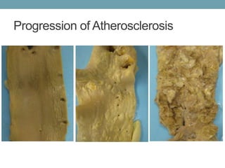 Progression of Atherosclerosis 
	 
 