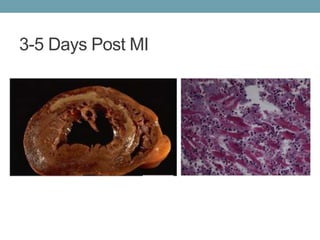 3-5 Days Post MI 
 