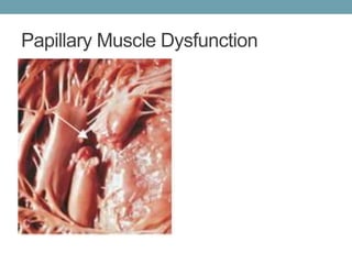 Papillary Dysfunction Cardiovascular Histology | PPTX